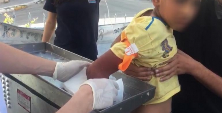 عملية جراحية لطفل سوري يده عالقة في ماكينة فرم اللحمة