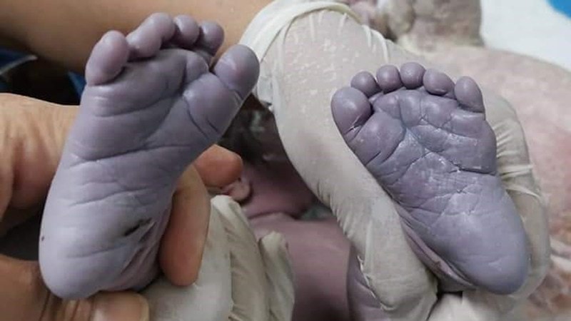 ولادة طفلة عراقية بـ6 أصابع في اليدين والقدمين
