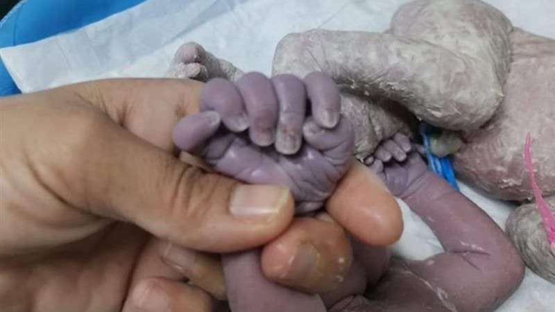 ولادة طفلة عراقية بـ6 أصابع في اليدين والقدمين