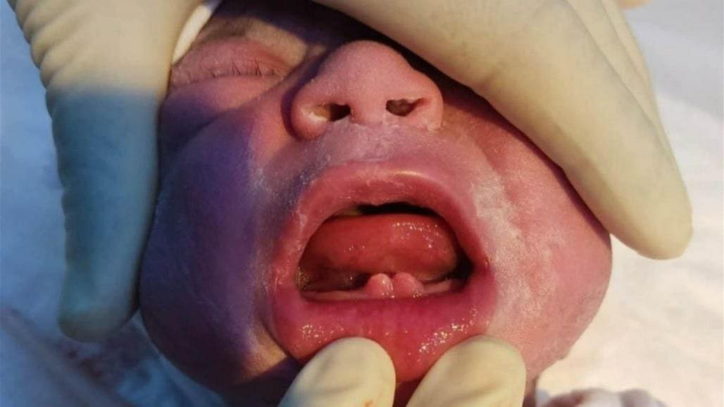 ولادة طفل بأسنان
